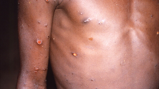 Lesiones en la piel provocadas por la viruela del mono.