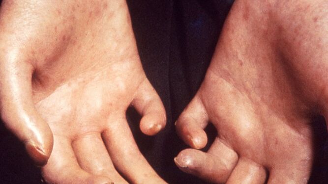 Hallan un factor genético que explica la enfermedad autoinmune que endurece la piel