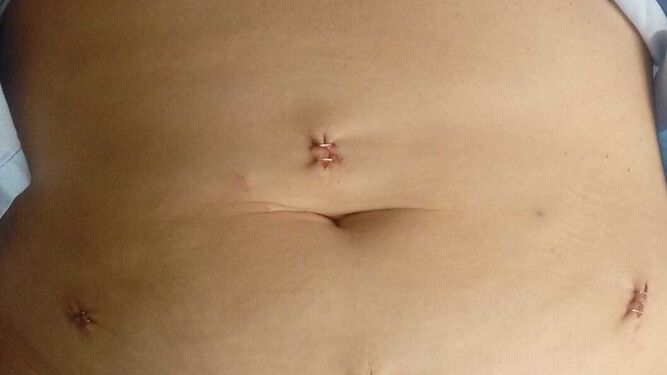 El abdomen de Virginia tras la histerectomía.