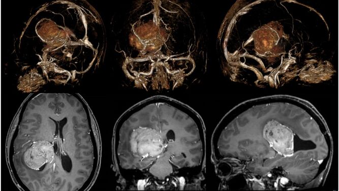 El Hospital Vithas de Granada extirpa con éxito un tumor cerebral de seis centímetros